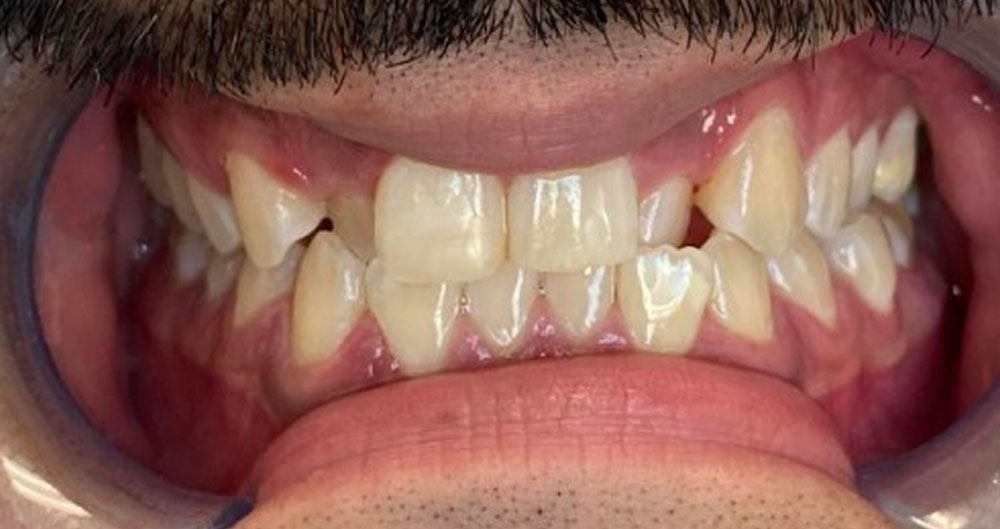 invisalign