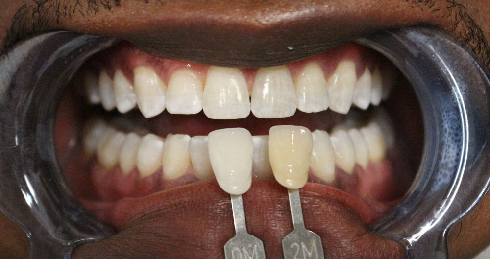 Dental Implants Houston Heights