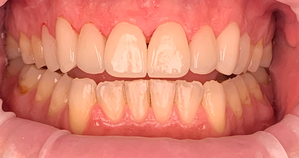 veneers-after