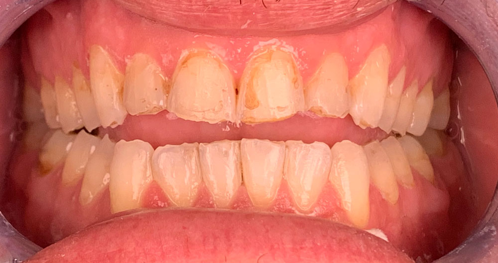 veneers-before